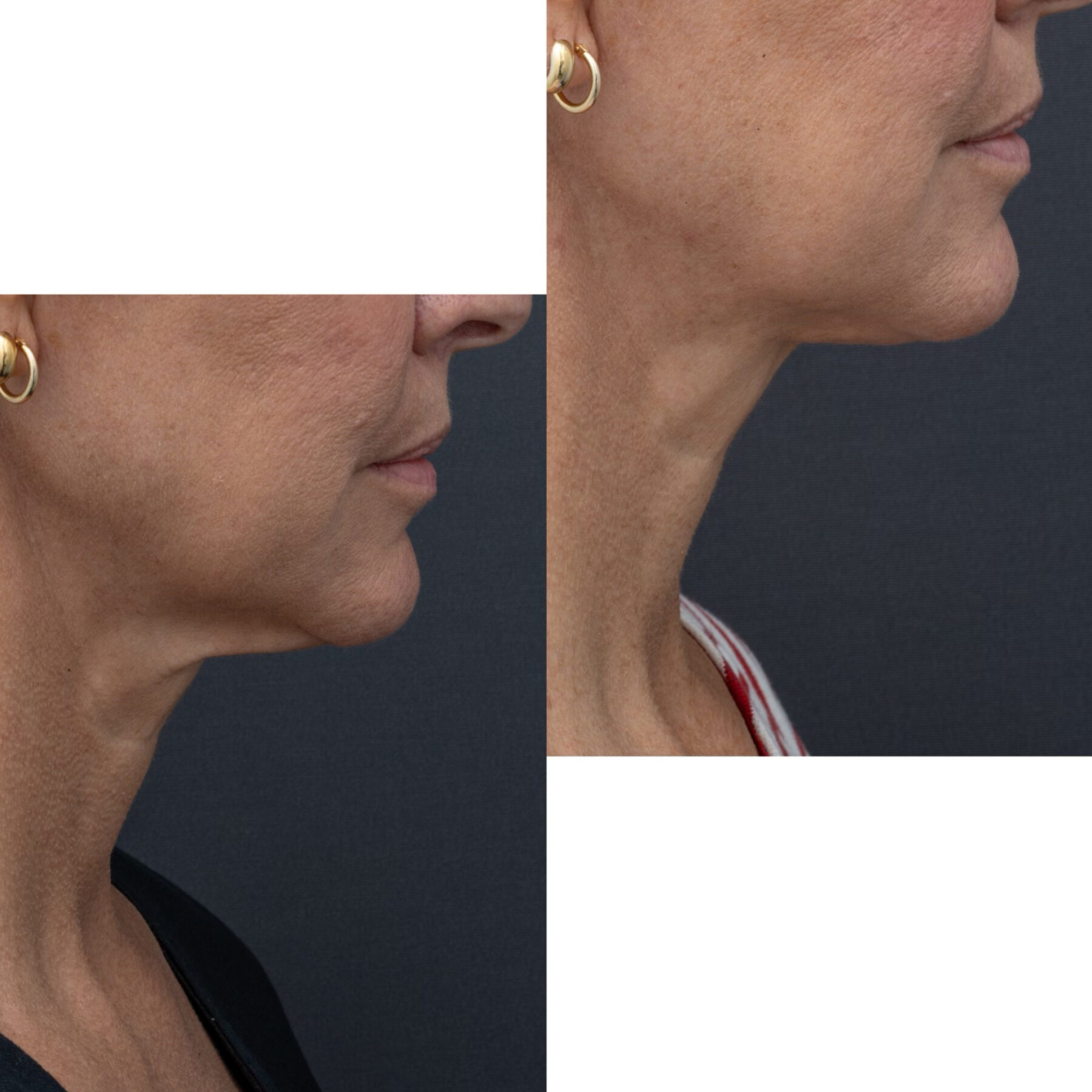 MyEllevate Minimal Invasive Neck Lift Sydney Shape Clinic