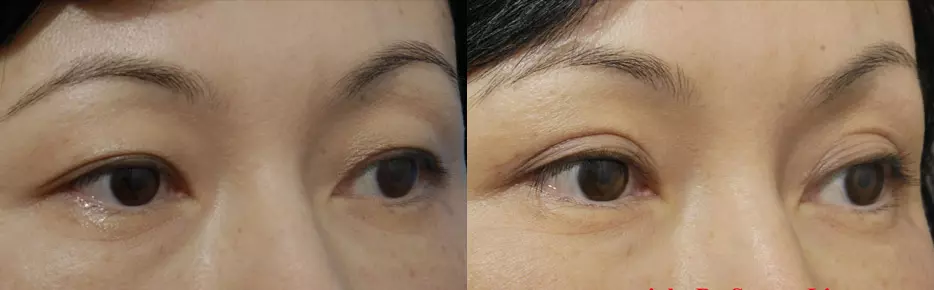 Chinese sale eye surgery