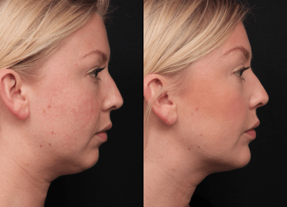 Double Chin Non Surgical Removal And Reduction Shape Clinic