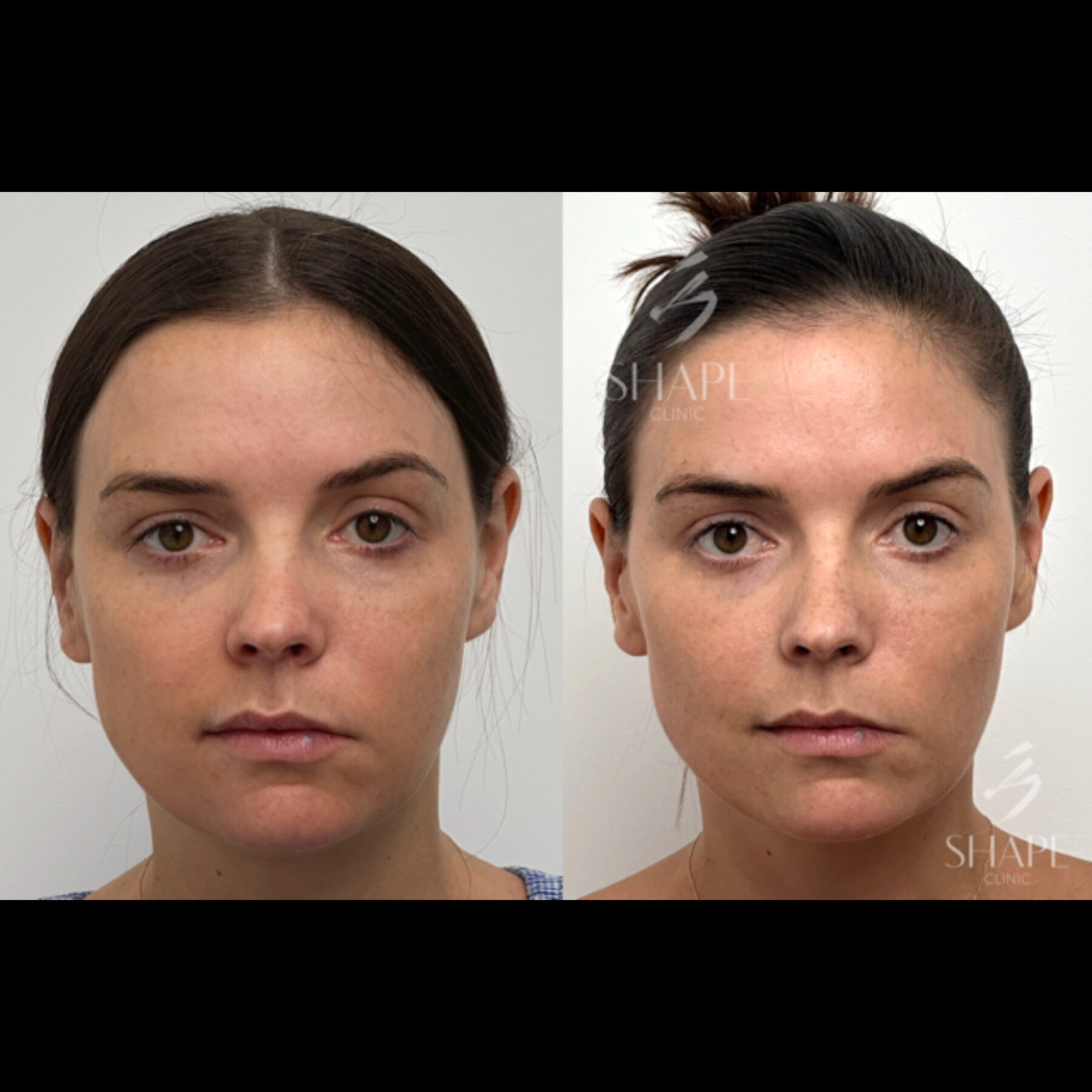 EMFACE Sydney | EMFACE Treatment | Shape Clinic